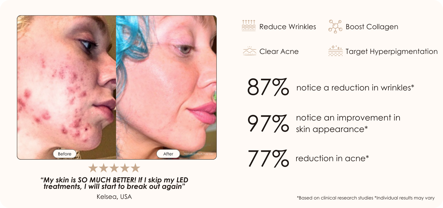 LightAura Flex LED face mask light therapy before and after results showing reduced acne