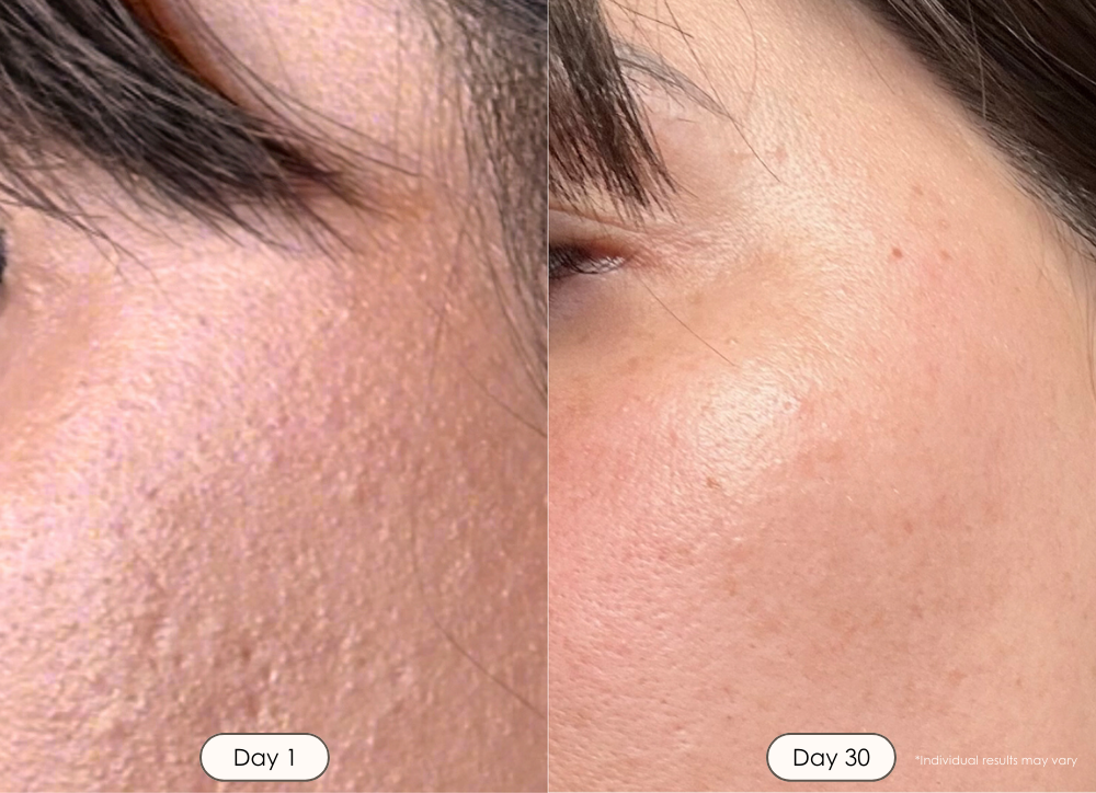 Reinvo microdermabrasion wand before and after results where pores are smaller and skin smoother